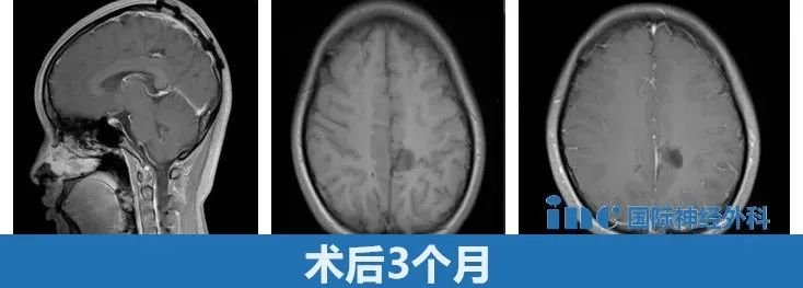 术后3个月随访