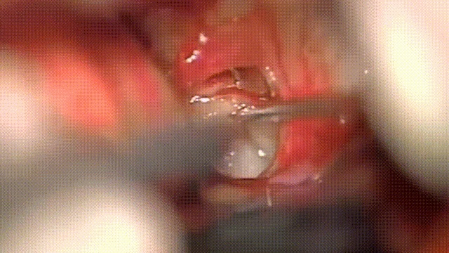 复杂视神经-下丘脑胶质瘤