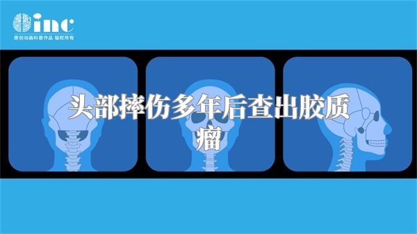 头部摔伤多年后查出胶质瘤