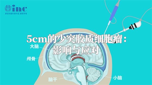 5cm的少突胶质细胞瘤：影响与应对