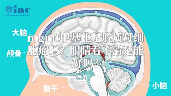 mgmt甲基化是胶质母细胞瘤吗？眼睛看不清楚能好吗？