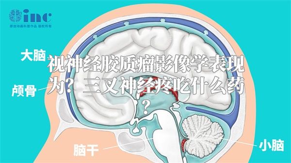 视神经胶质瘤影像学表现为？三叉神经疼吃什么药？