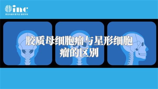 胶质母细胞瘤与星形细胞瘤的区别