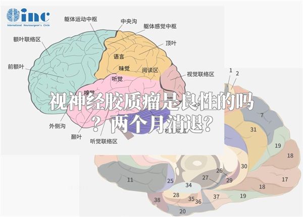 视神经胶质瘤是良性的吗？两个月消退？