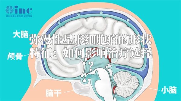 弥漫性星形细胞瘤的形状特征：如何影响治疗选择？