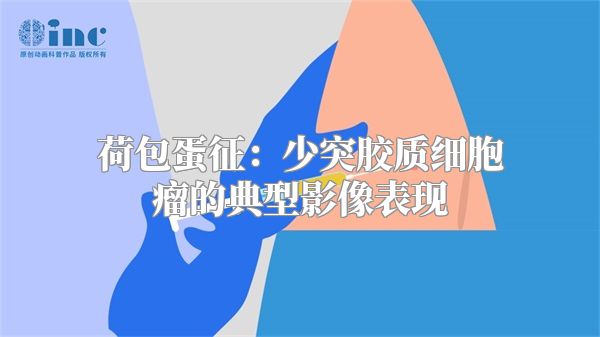 荷包蛋征：少突胶质细胞瘤的典型影像表现