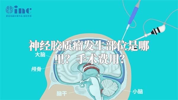 神经胶质瘤发生部位是哪里？手术费用？