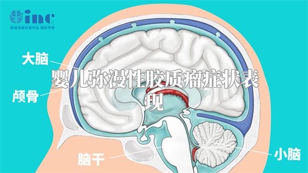 婴儿弥漫性胶质瘤症状表现
