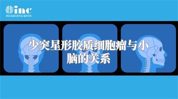 少突星形胶质细胞瘤与小脑的关系