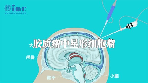 胶质瘤中星形细胞瘤
