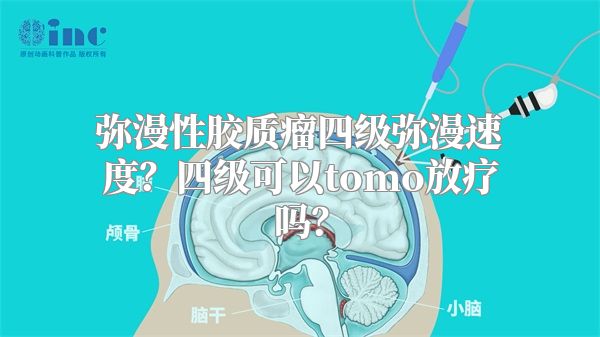 弥漫性胶质瘤四级弥漫速度？四级可以tomo放疗吗？