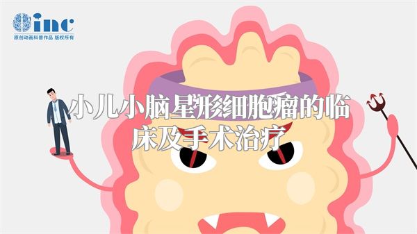 小儿小脑星形细胞瘤的临床及手术治疗