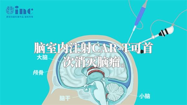 脑室内注射CAR-T可首次消灭脑瘤。