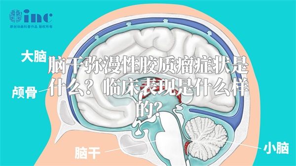脑干弥漫性胶质瘤症状是什么？临床表现是什么样的？