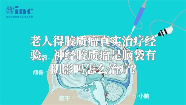老人得胶质瘤真实治疗经验，神经胶质瘤是脑袋有阴影吗怎么治疗？