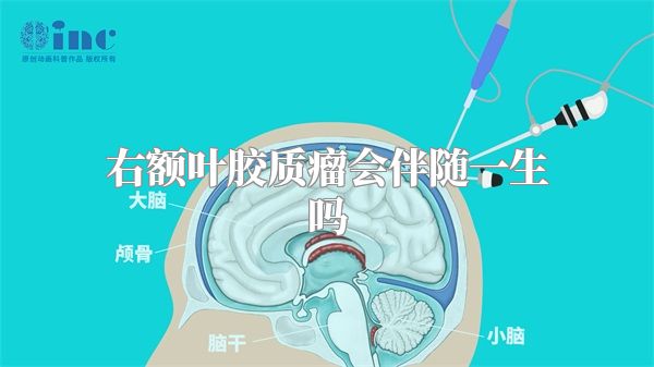 右额叶胶质瘤会伴随一生吗