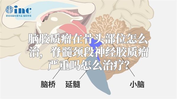脑胶质瘤在骨头部位怎么治，脊髓颈段神经胶质瘤严重吗怎么治疗？