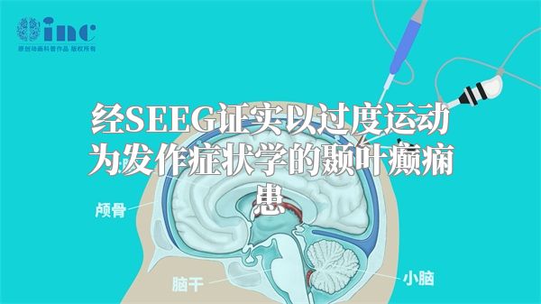 经SEEG证实以过度运动为发作症状学的颞叶癫痫患