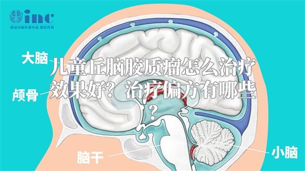 儿童丘脑胶质瘤怎么治疗效果好？治疗偏方有哪些？