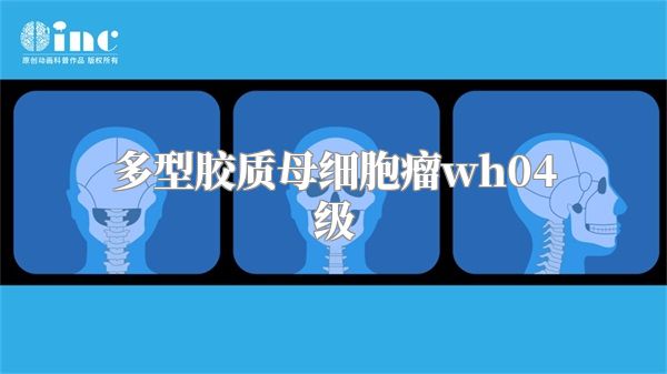 多型胶质母细胞瘤wh04级