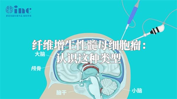 纤维增生性髓母细胞瘤：认识这种类型