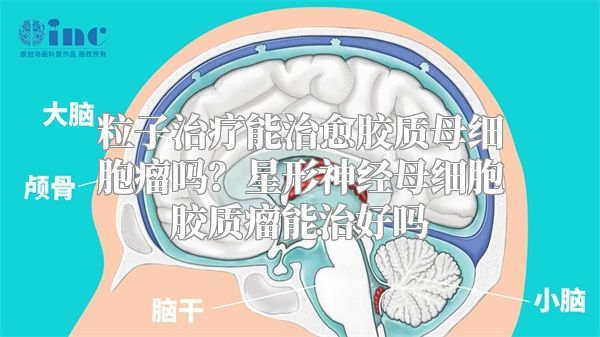 粒子治疗能治愈胶质母细胞瘤吗？星形神经母细胞胶质瘤能治好吗