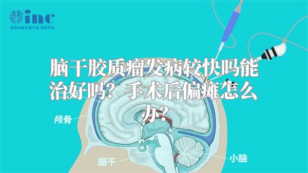 脑干胶质瘤发病较快吗能治好吗？手术后偏瘫怎么办？