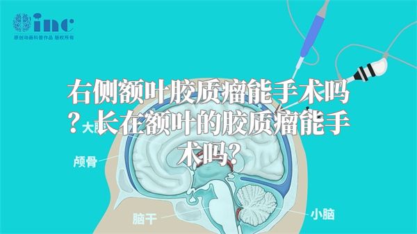 右侧额叶胶质瘤能手术吗？长在额叶的胶质瘤能手术吗？