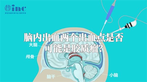 脑内出血两个出血点是否可能是胶质瘤？