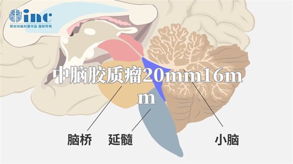 中脑胶质瘤20mm16mm