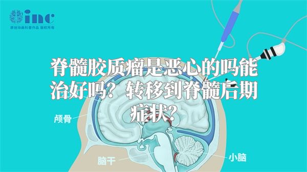 脊髓胶质瘤是恶心的吗能治好吗？转移到脊髓后期症状？