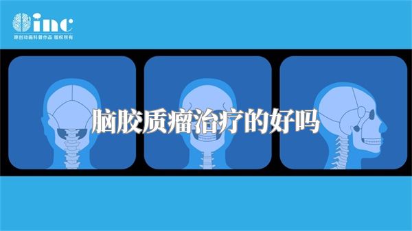 脑胶质瘤治疗的好吗