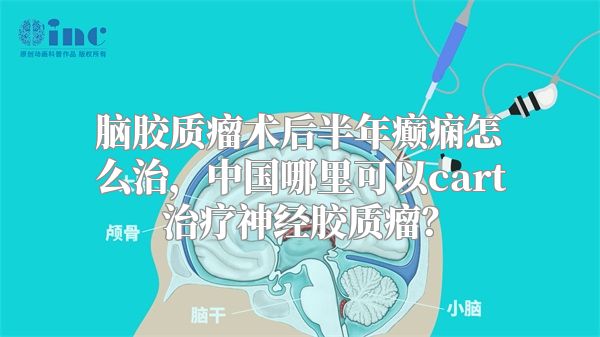 脑胶质瘤术后半年癫痫怎么治，中国哪里可以cart治疗神经胶质瘤？