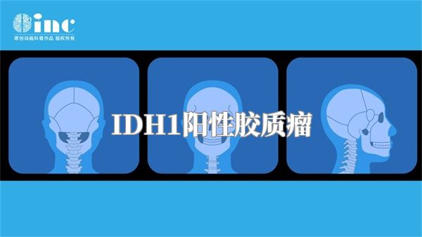 IDH1阳性胶质瘤