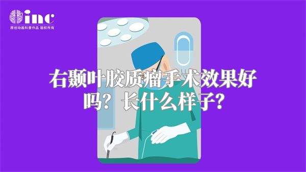 右颞叶胶质瘤手术效果好吗？长什么样子？