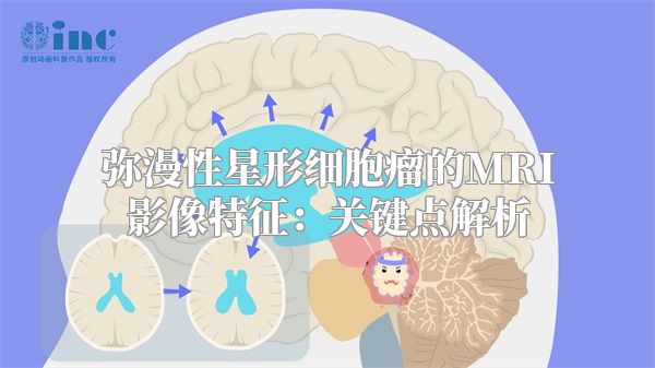 弥漫性星形细胞瘤的MRI影像特征：关键点解析