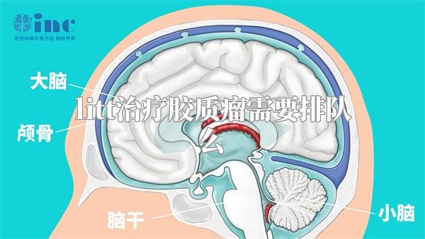 litt治疗胶质瘤需要排队么