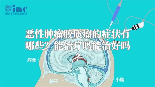 恶性肿瘤胶质瘤的症状有哪些？能治疗吗能治好吗？