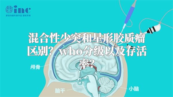 混合性少突和星形胶质瘤区别？who分级以及存活率？