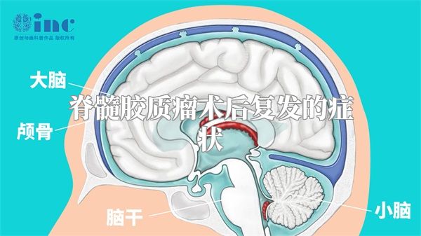 脊髓胶质瘤术后复发的症状