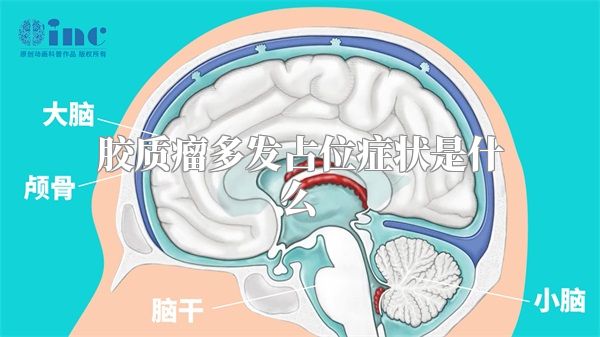 胶质瘤多发占位症状是什么