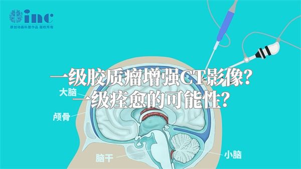 一级胶质瘤增强CT影像？一级痊愈的可能性？