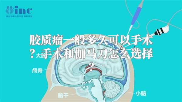 胶质瘤一般多久可以手术？手术和伽马刀怎么选择？