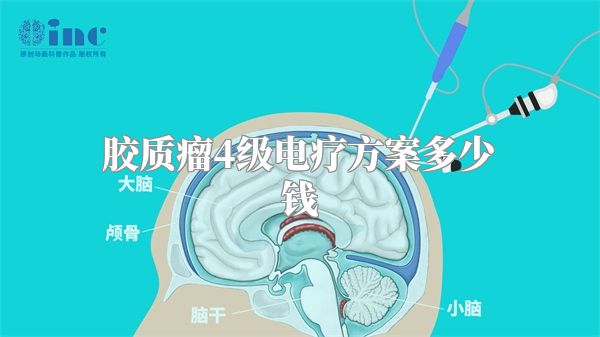 胶质瘤4级电疗方案多少钱