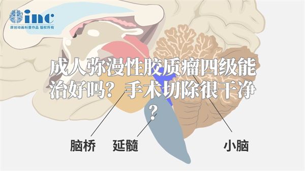 成人弥漫性胶质瘤四级能治好吗？手术切除很干净？