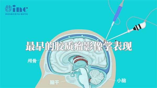 最早的胶质瘤影像学表现