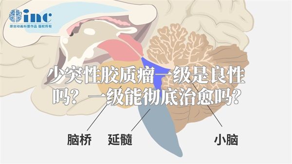 少突性胶质瘤一级是良性吗？一级能彻底治愈吗？
