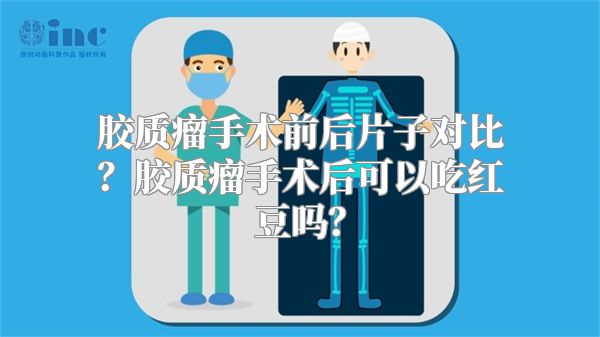 胶质瘤手术前后片子对比？胶质瘤手术后可以吃红豆吗？