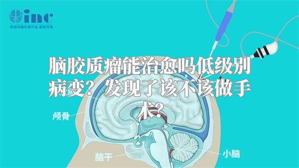 脑胶质瘤能治愈吗低级别病变？发现了该不该做手术？