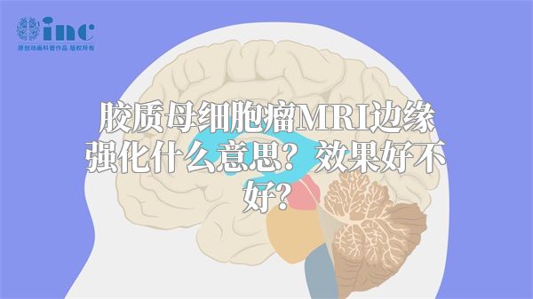 胶质母细胞瘤MRI边缘强化什么意思？效果好不好？